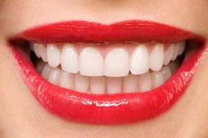 دندانپزشکی زیبایی - ونیر