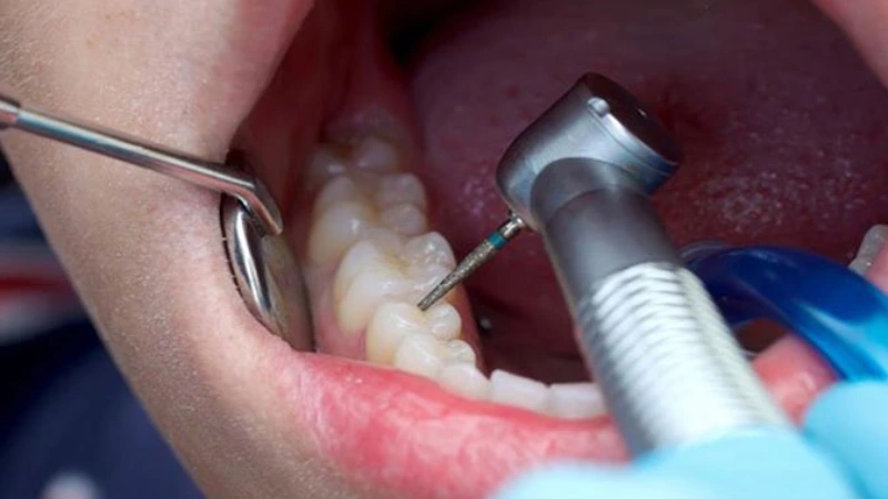 روش‌های درمان ریشه دندان