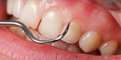 کلینیک دندانپزشکی آرکا - جراحی لثه