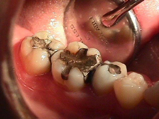 amalgma_dental