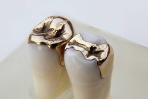 مزایای ترمیم دندان با طلا