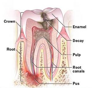 موارد نیاز به درمان ریشه دندان