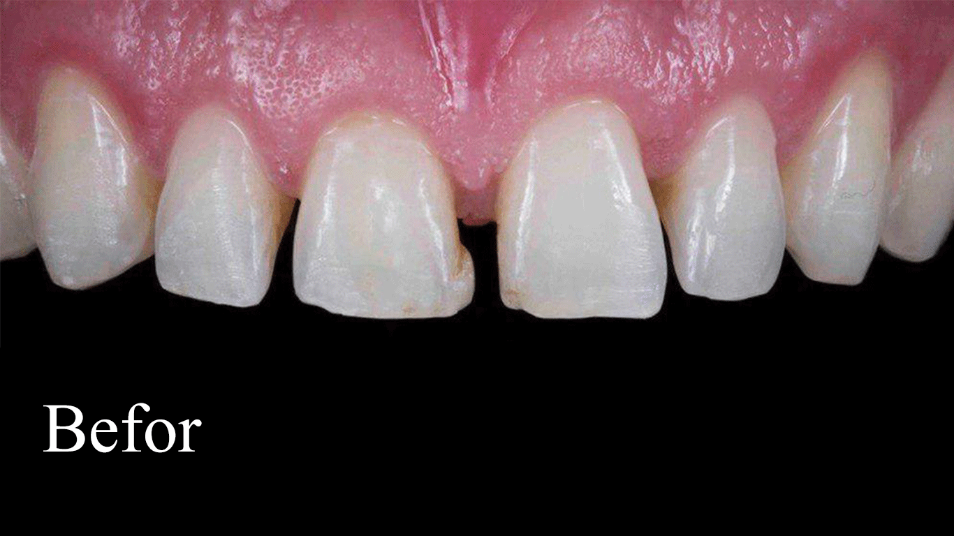 ونیر-کامپوزیت-دندان-قبل-از-درمان