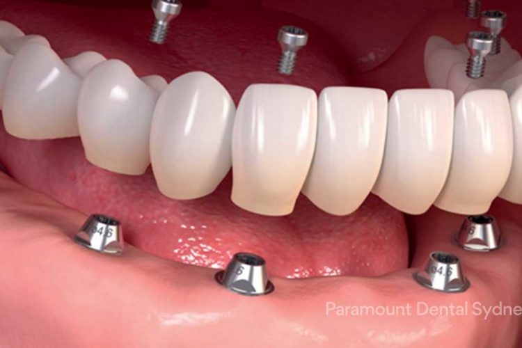 پروتز دندانی - اوردنچر
