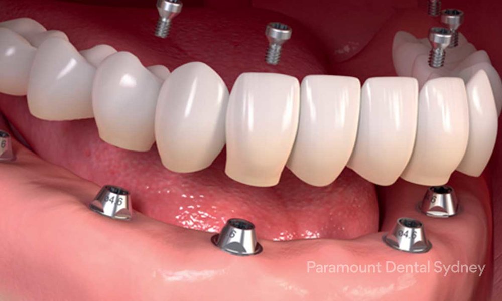 پروتز دندانی - اوردنچر