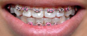 کلینیک دندانپزشکی آرکا - ارتودنسی سیمی