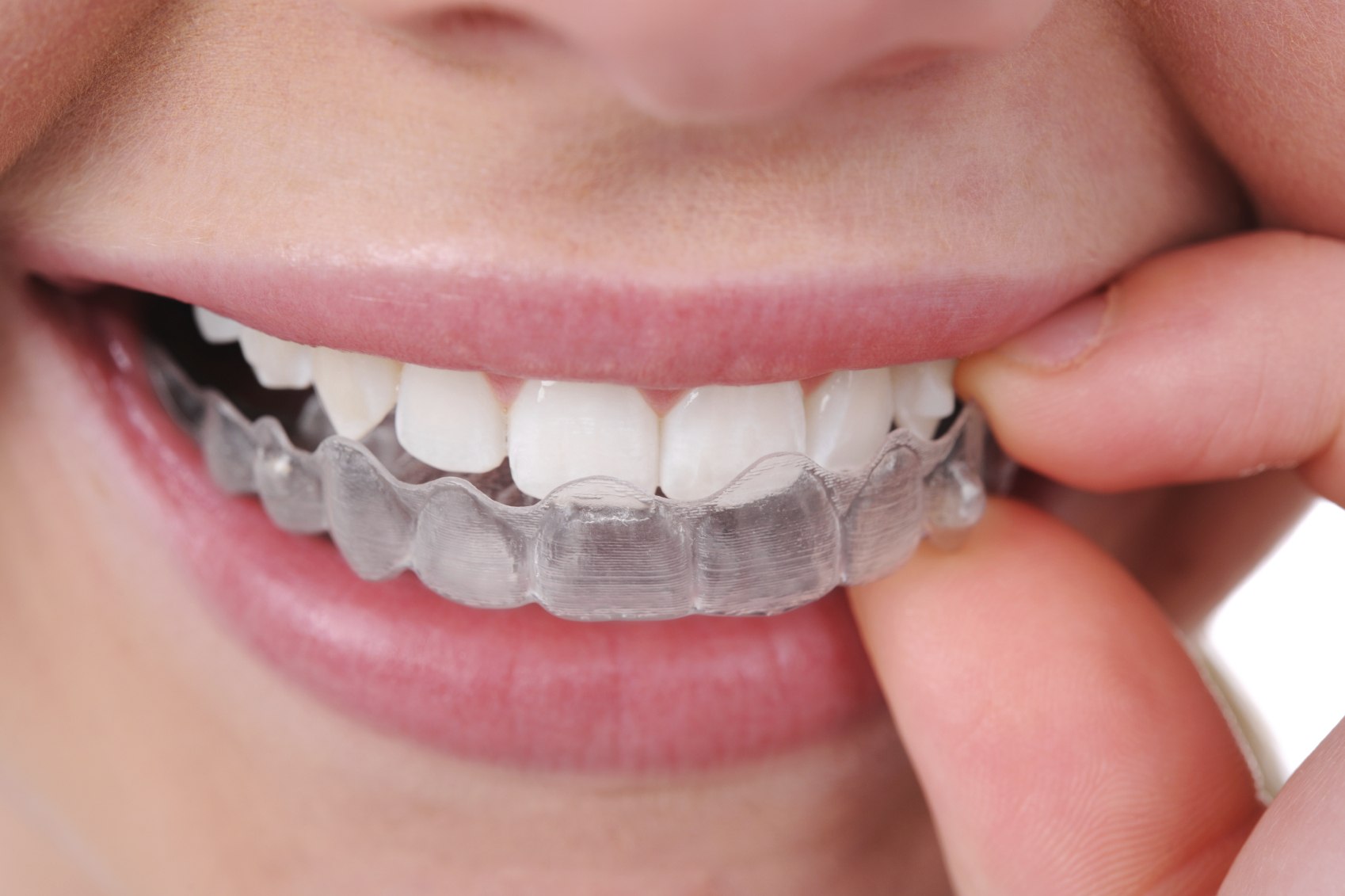 کلینیک دندانپزشکی آرکا - ارتودنسی نامرئی