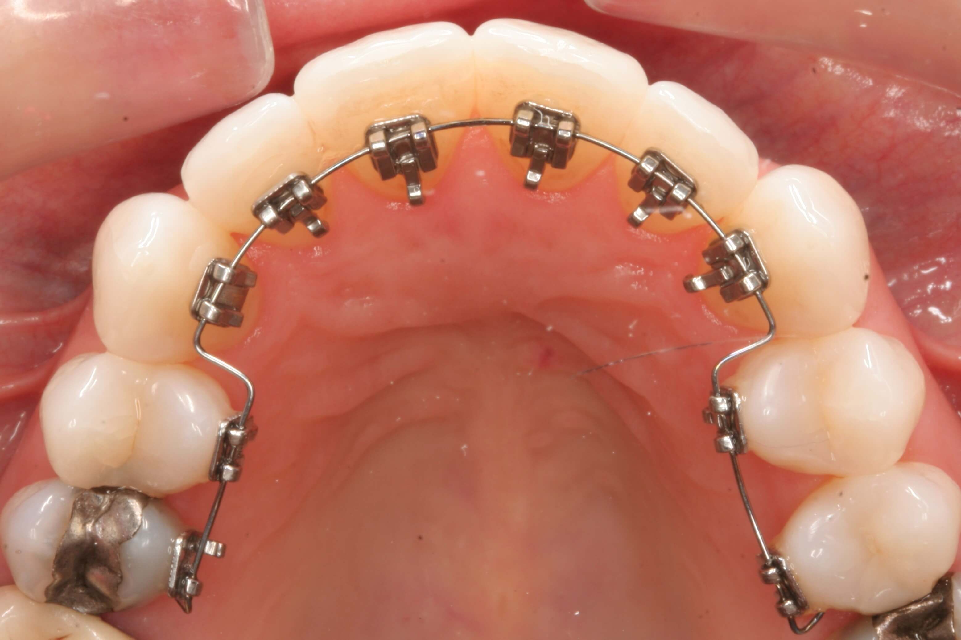 کلینیک دندانپزشکی آرکا - ارتودنسی نامرئی (لینگوال)