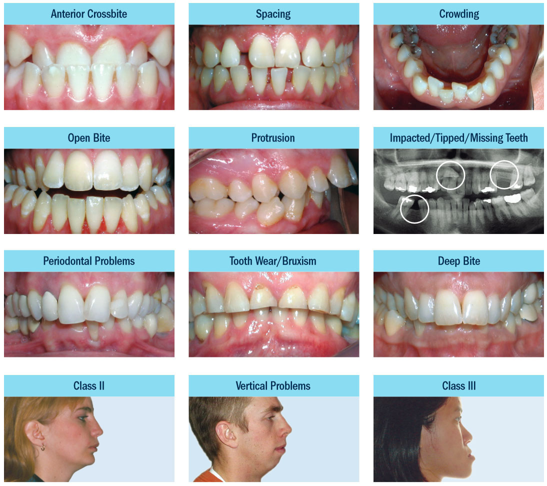 کلینیک دندانپزشکی آرکا - انواع ناهنجاری های دهان و دندان در ارتودنسی