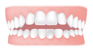 کلینیک دندانپزشکی آرکا - اپن بایت قدامی