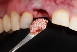 بازسازی استخوان - GBR برای انجام ایمپلنت دندان
