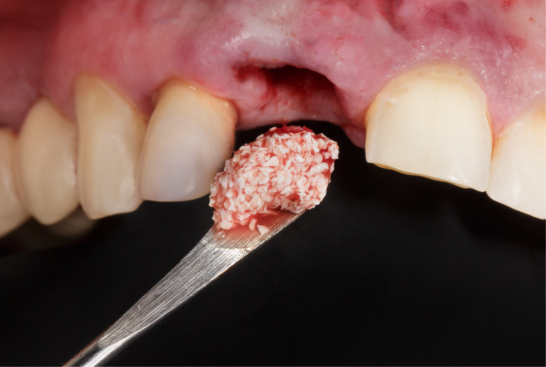 کلینیک دندانپزشکی آرکا - ایمپلنت دندان - پودر استخوان