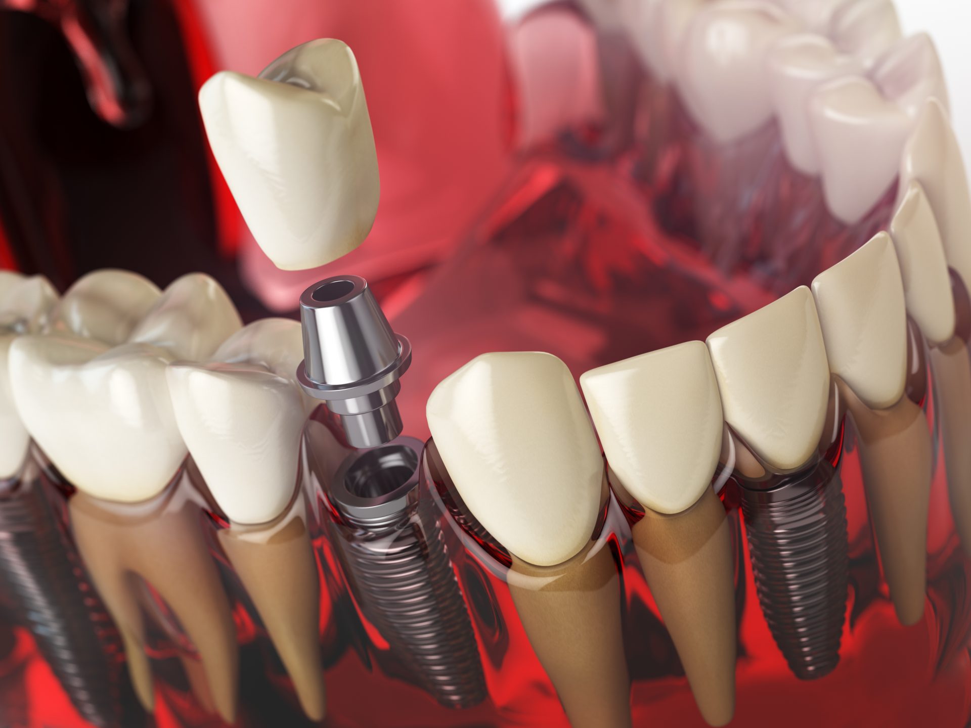 کلینیک دندانپزشکی آرکا - ایمپلنت دندان
