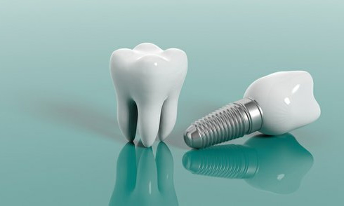 کلینیک دندانپزشکی آرکا - ایمپلنت دندان