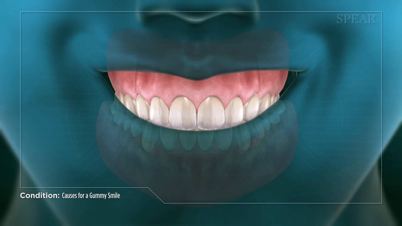 کلینیک دندانپزشکی آرکا - جراحي لثه