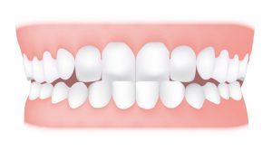 کلینیک دندانپزشکی آرکا - جلو بودن فک پایین