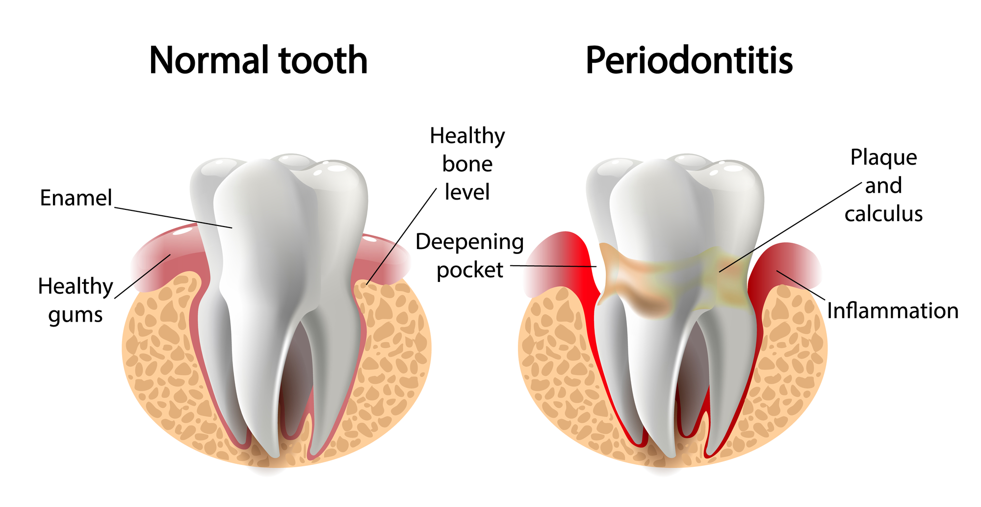 کلینیک دندانپزشکی آرکا - درمانهاي غيرجراحي لثه