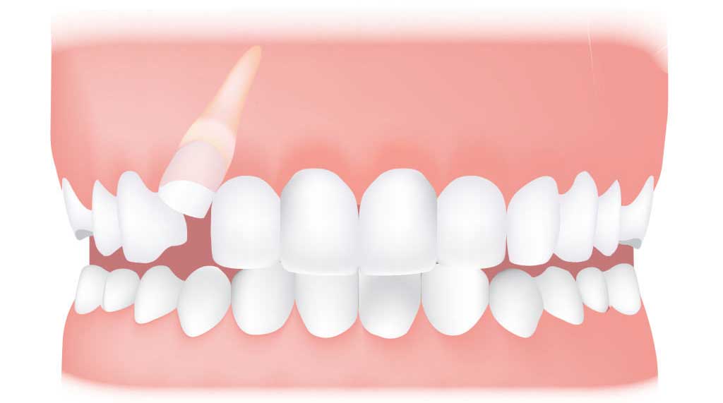 کلینیک دندانپزشکی آرکا - دندان نیش نهفته