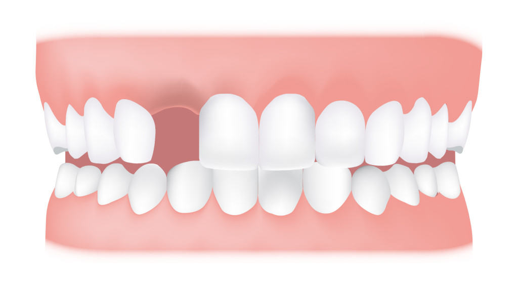 کلینیک دندانپزشکی آرکا - دندانهای غائب