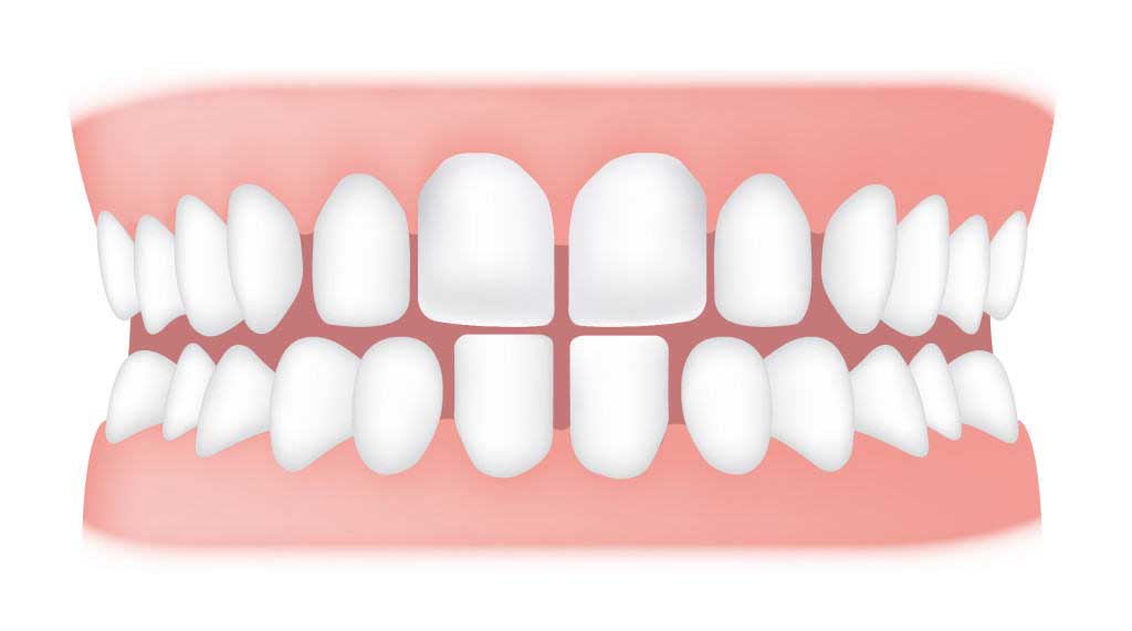 کلینیک دندانپزشکی آرکا - دندانهای فاصله دار