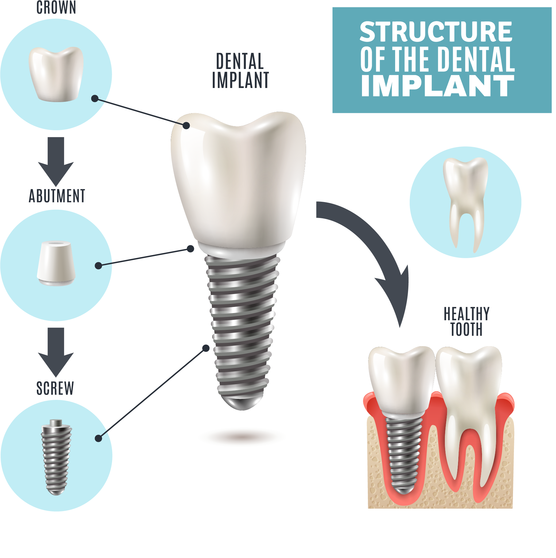 کلینیک دندانپزشکی آرکا - ساختار ایمپلنت دندان