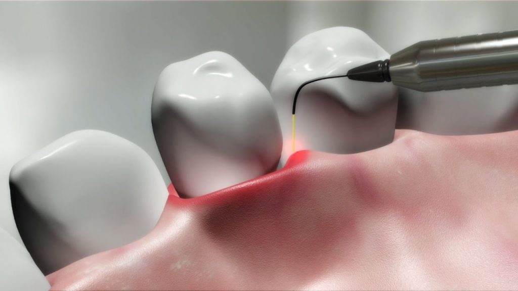 کلینیک دندانپزشکی آرکا - لیزر در جراحي لثه