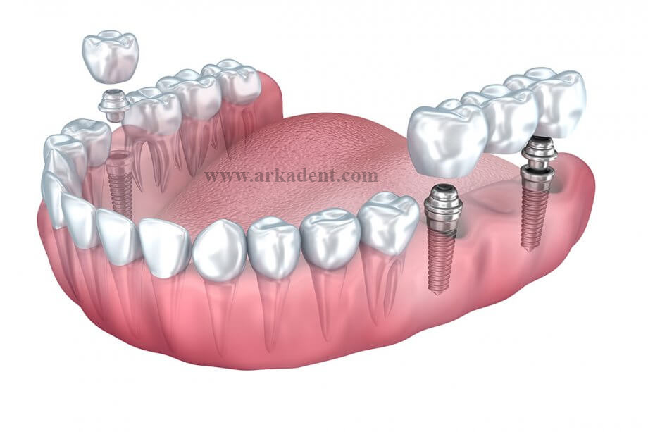 کلینیک دندانپزشکی آرکا - مزایای ایمپلنت دندان نسبت به سایر درمانهای جایگزین