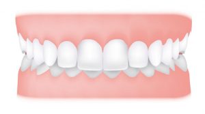 کلینیک دندانپزشکی آرکا - همپوشانی دندانها