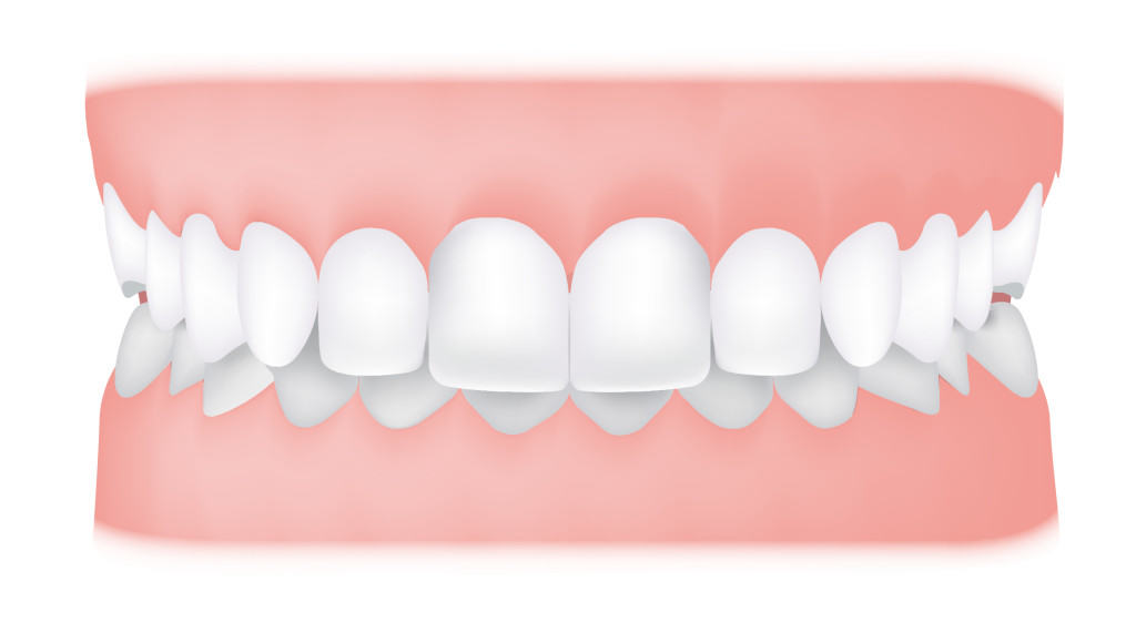 کلینیک دندانپزشکی آرکا - همپوشانی دندانها