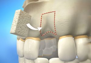 کلینیک دندانپزشکی آرکا - پیوند استخوان یا گرافت جهت ایمپلنت دندان