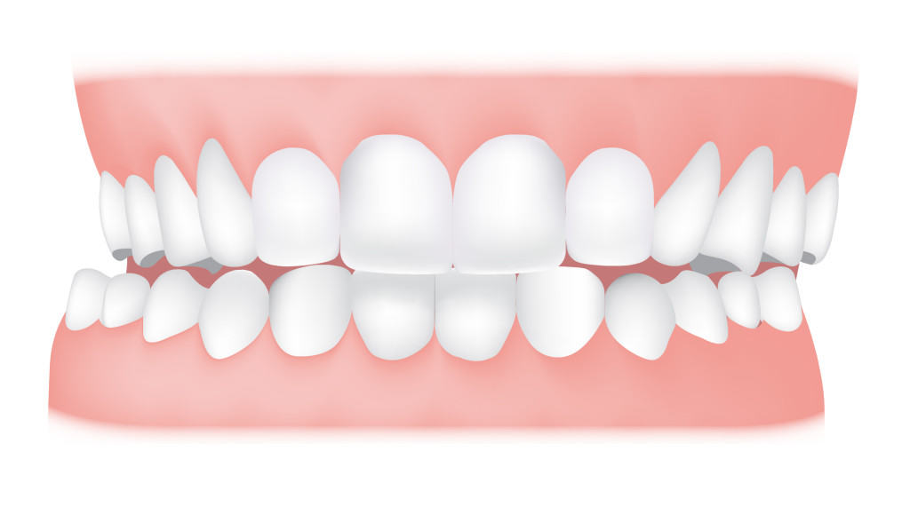 کلینیک دندانپزشکی آرکا - کراس بایت