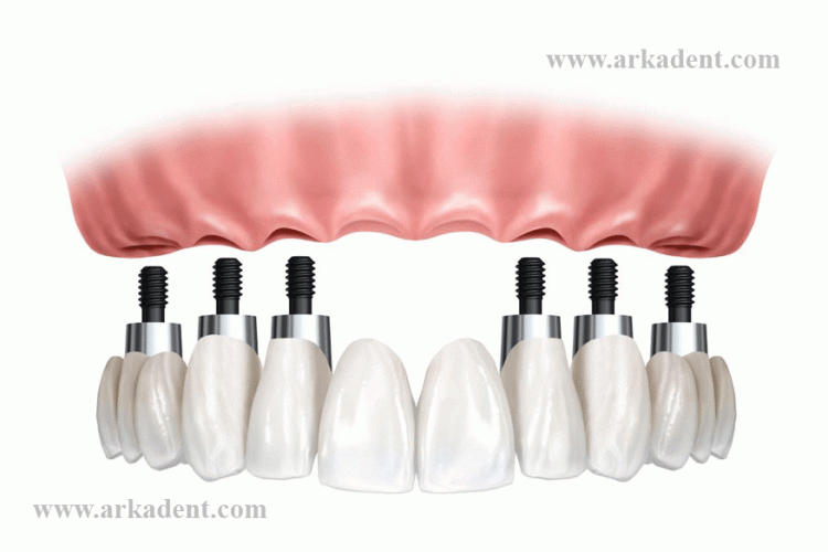 فواید درمان به موقع ایمپلنت دندان