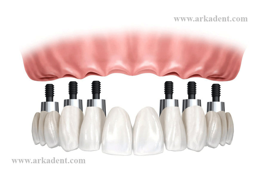 کیلینیک-دندانپزشکی-آرکا---ایمپلنت-دندان