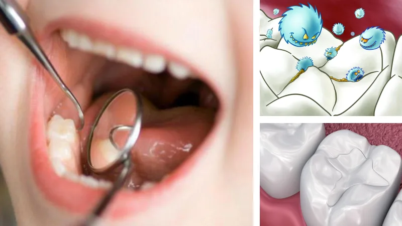 فیشورسیلانت دندان چیست؟