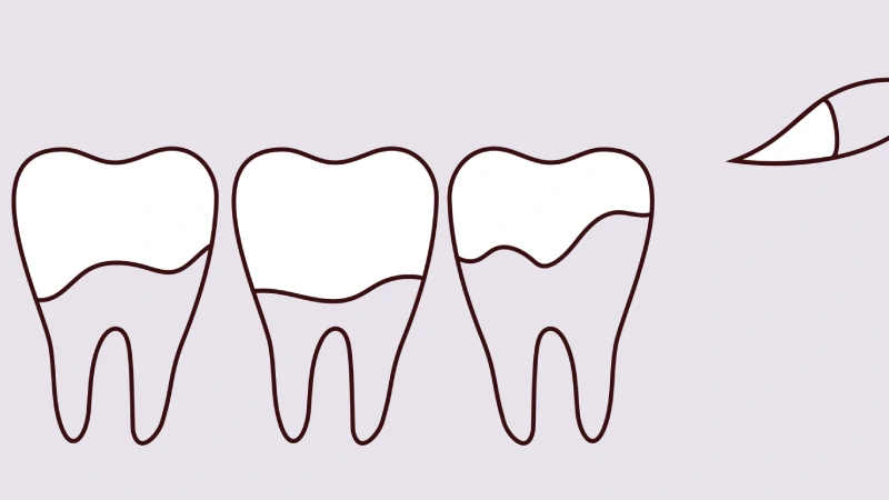 پوسیدگی دندان در چه کسانی بیشتر محتمل است؟