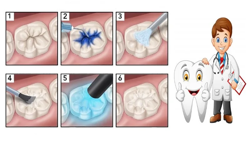 چگونه سیلانت روی دندان‌ها قرار داده می‌شود؟