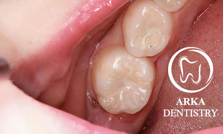 کلینیک دندانپزشکی آرکا - فیشورسیلانت ۳