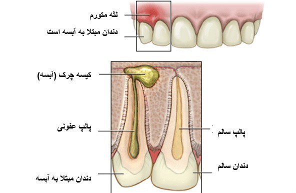 عفونت پالپ و آبسه دندان