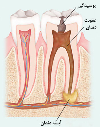 عفونت ریشه دندان