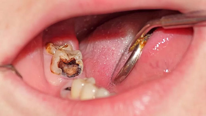 دندان عفونت کرده و عوامل آن