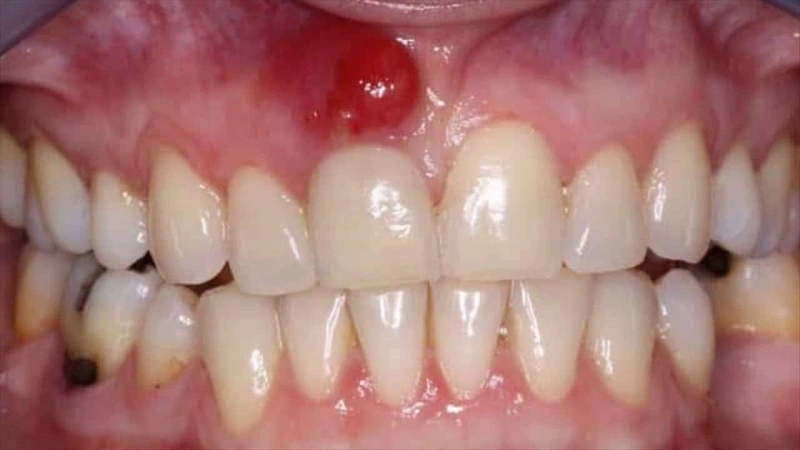 چه زمانی باید نگران سرایت عفونت دندان به قسمت‌های دیگر بدن شد؟