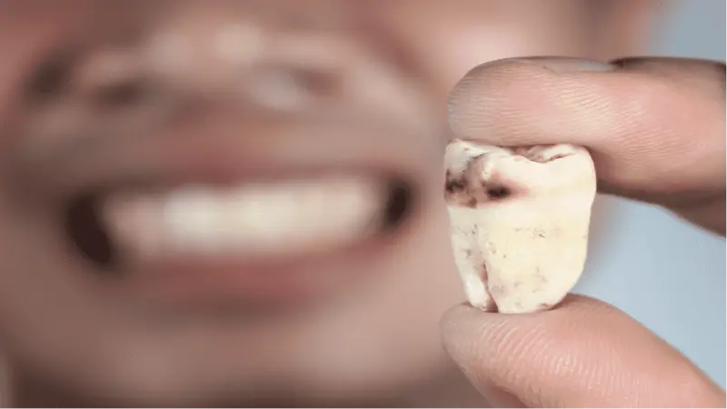 کدام قسمت از دندان بیشتر پوسیده می شود؟