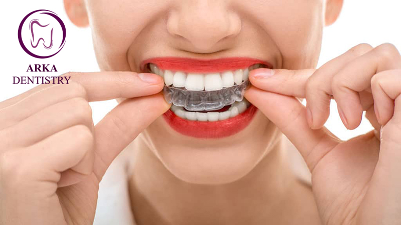 کلینیک دندانپزشکی آرکا - بلیچینگ ۱۱