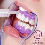 کلینیک دندانپزشکی آرکا - بلیچینگ ۱۲