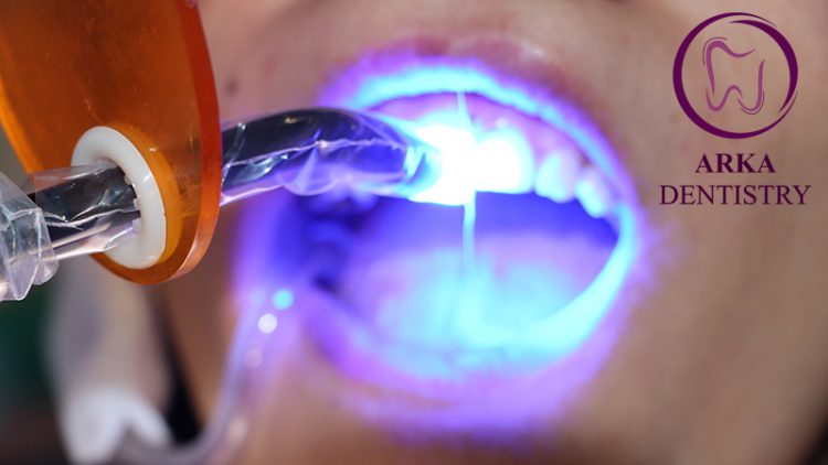مراقبتهای بعد از بلیچینگ دندان