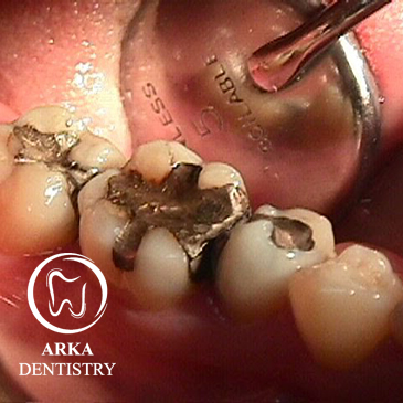 کلینیک دندانپزشکی آرکا-ترمیم دندان۱