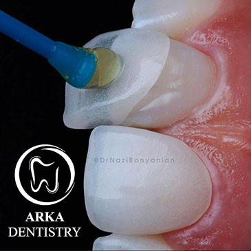 کلینیک دندانپزشکی آرکا - لمینیت ۲