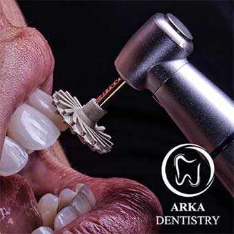 کلینیک دندانپزشکی آرکا - ونیر کامپوزیت۳