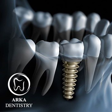 کیلینیک دندانپزشکی آرکا - ایمپلنت دندان ۱