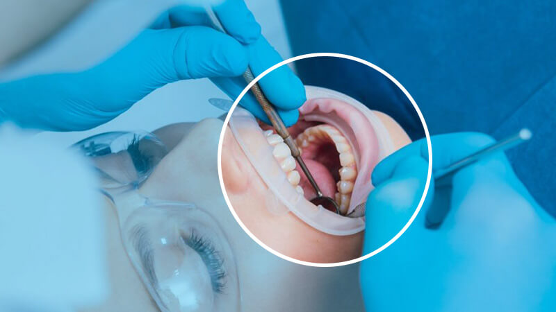 کشیدن دندان عقل - بعد از عمل